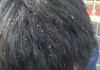解梦头上有头皮屑什么意思