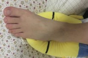 左脚摔骨折，揭秘其背后的奥秘