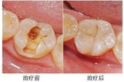 解梦压牙漏个窟窿，解读梦境中的牙洞符号