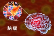 脑瘤是什么不好？师教你避开脑瘤的秘密