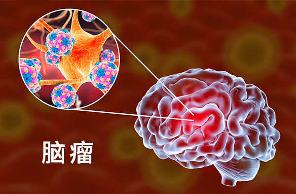 脑瘤是什么不好？师教你避开脑瘤的秘密,风水布局,气场,能量,第1张