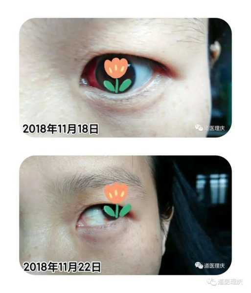 解梦双眼出血预兆,象征,解梦,自我,第1张