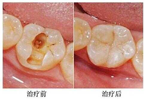 解梦压牙漏个窟窿，解读梦境中的牙洞符号,象征,解梦,健康状况,第1张