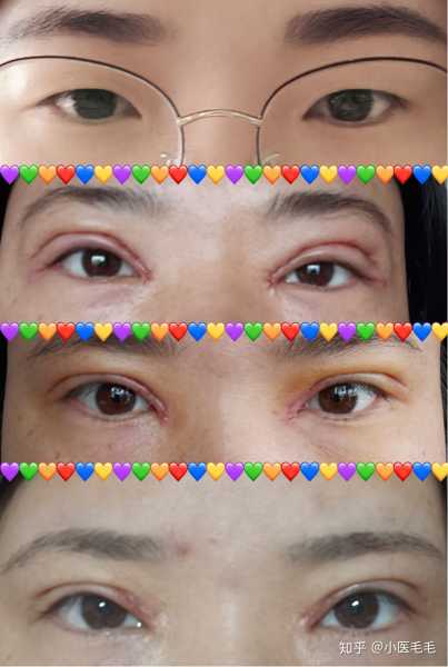 割双眼皮忌讳，揭秘禁忌，让你美丽无忧,风水,第1张